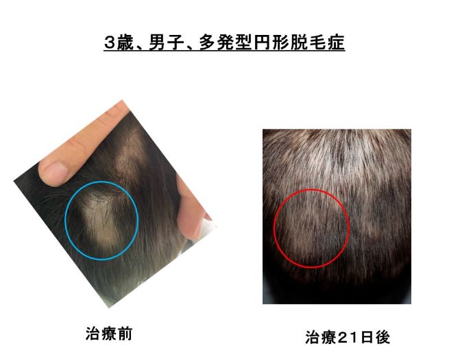 円形脱毛症　病院